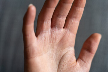 Keratosis pilaris on the hands causing very dry skin during winter season. Hand eczema needs a lot...