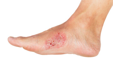 Wounds and dry skin on human foot. Ulcers and infection of medical concepts.