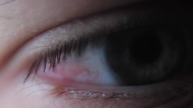 Close up of a severe bloodshot red eye. Irritated or infected eye. Coronavirus.