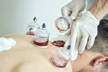 Healing bloodletting, hijama, or phlebotomy