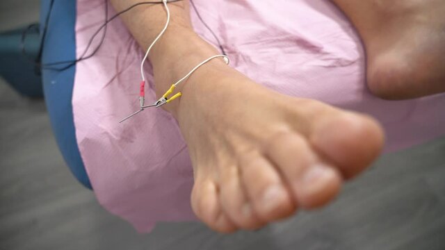 Top view of ankle with needle and electricity for medical treatment and sprained ankle
