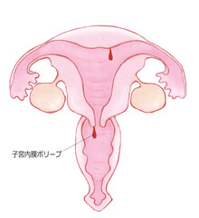 子宮頸管（内膜）ポリープ　名称あり