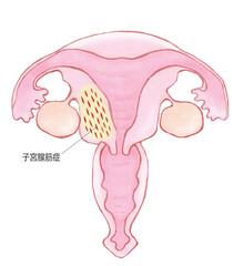 子宮腺筋症　名称あり