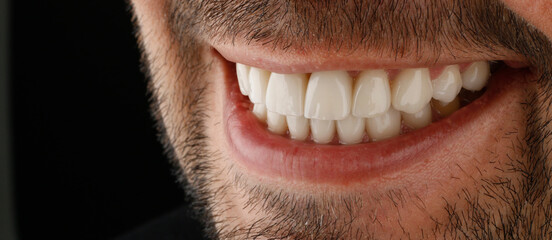 smile design with dental laminate veneers 