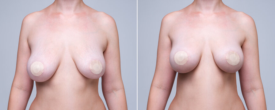 Before and after breast augmentation concept, woman with large silicone breasts after correction surgery