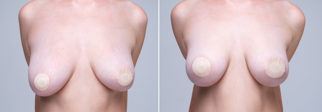 Before and after breast augmentation concept, woman with large silicone breasts after correction surgery