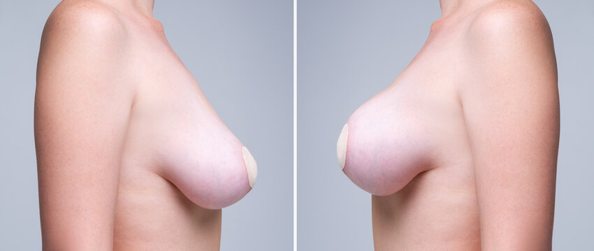 Before and after breast augmentation concept, woman with large silicone breasts after correction surgery