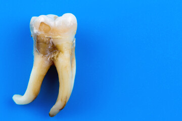 A real human tooth is affected by caries and with a curved root at an angle of almost 90 degrees.