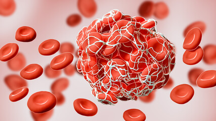Close-up of a coagulated clot of red blood cells entangled in fibrin 3D rendering illustration. Thrombus, thrombosis, blood circulation, pathology, medical, science concepts.