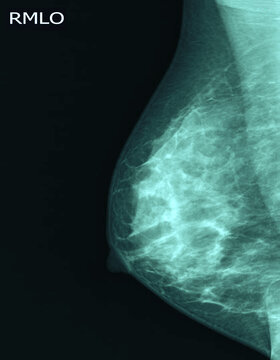 breast x-ray images from checkup mammogram of women patient.