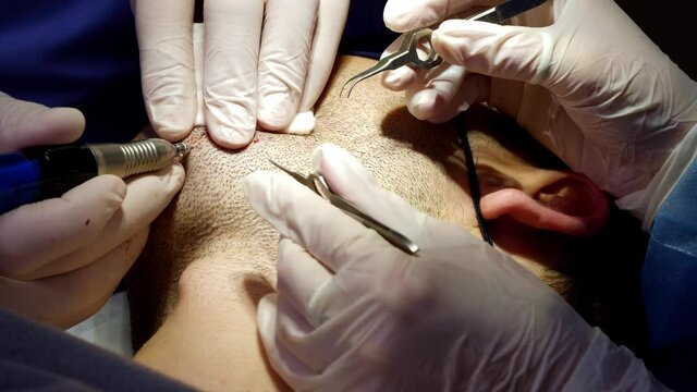 Doctors harvesting beard hair from patient to transplant to scalp, FUE (sequence 3 of 7)