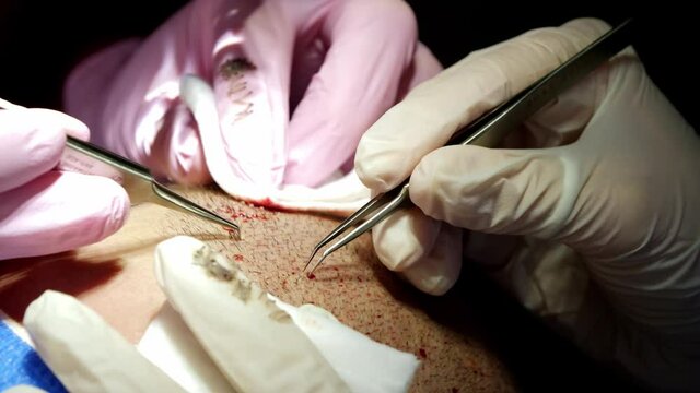 Doctors harvesting individual hair follicles from the beard with FUE method for transplantation (sequence 4 of 7)