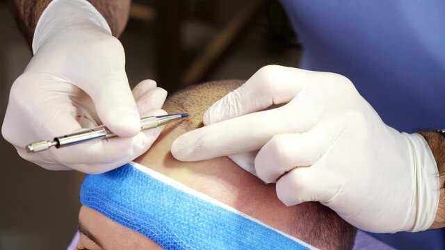 Doctor implanting hair follicles on scalp to treat baldness in live clinical setting (sequence 7 of 7)