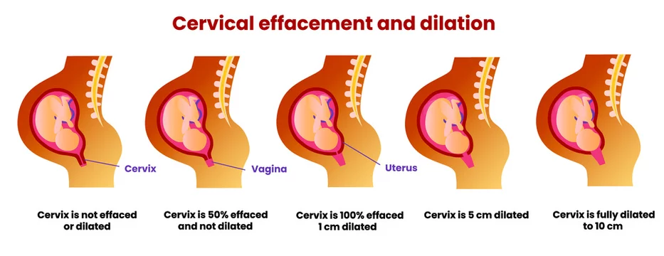 Cervical effacement and dilation during childbirth. 1 cm, 5 cm and 10 cm  dilated. Vector realistic medical illustration Stock Vector | Adobe Stock