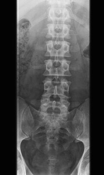 x-ray photo of human lumbar spine - adult man, front view