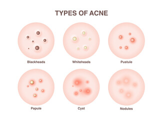 Types of acne, pimples, skin pores, blackhead, whitehead, scar, comedone. Vector icons of skin acne pimples, cosmetology and skincare problems.