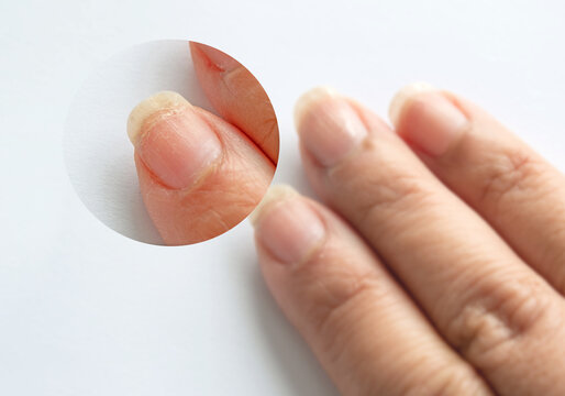 Zoomin Image Of Brittle Weak Dry Cracked Pitted Woman's Fingernails Surface And Prone To Breakage Caused By Harsh Ingredients In Nail Polish Formulas On White Background.