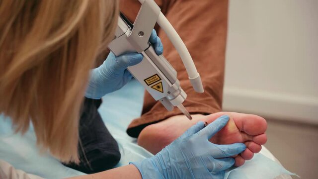 Laser removal of warts on the foot. Medical dermatological surgery in the clinic.