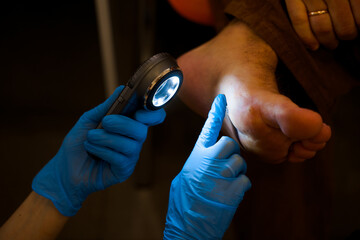 Laser removal of warts on the foot. Medical dermatological surgery in the clinic.