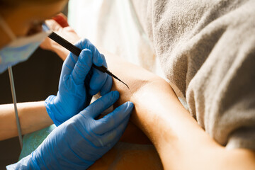 Fototapeta na wymiar Radio wave removal of papillomas on a woman's hand. Rejuvenation cosmetology. Skin care.