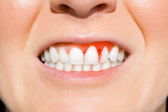 Woman with bleeding gums. Periodontal disease, avitaminosis, gingivitis, scurvy