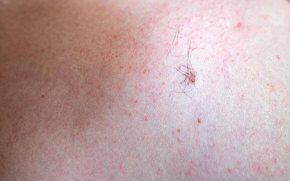 mole with excessive hair growth on a caucasian patient skin