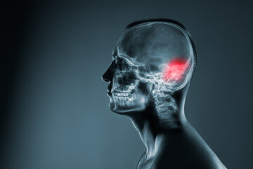 X-ray of a man's head. Cerebral stroke. Brain damage is highlighted by red colour.