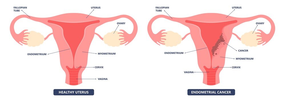Cancer pelvic PCOS ovary Endo belly pain swelling uterus heavy ovaries cysts examine surgery remove pregnancy endobelly tube cycle period Fertility problem diagnosis menstruation cell polyp cervical