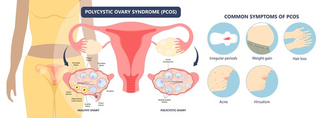 Cancer pelvic PCOS ovary Endo belly pain swelling uterus heavy ovaries cysts examine surgery remove pregnancy endobelly tube cycle period Fertility problem diagnosis menstruation cell polyp cervical