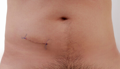 Fototapeta premium cooked wound with stitches for appendicitis operation