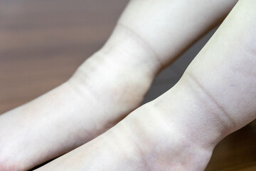 ソックス跡が残った浮腫んだ女性の足