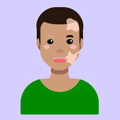 Flat cartoon vector illustration, that displays people pigmentation features. The man avatar with light skin and vitiligo. International Day for Tolerance