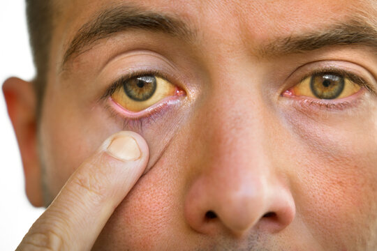 Young man with yellowish eyes and skin, liver disease. Symptoms of high bilirubin. Jaundice, hepatosis, hepatitis, cirrhosis, liver failure. Alcohol and nicotine harmful effects