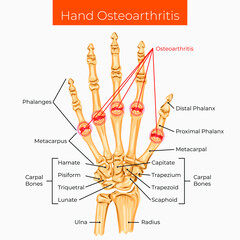Vector illustration. Hand osteoarthritis poster.