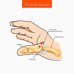 Vector illustration. Thumb sprain poster.