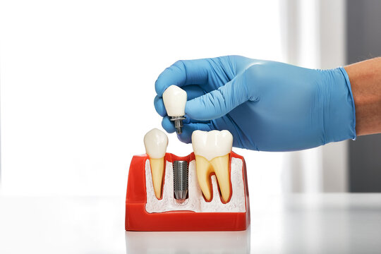 Dentist showing the installation of a dental implant on the anatomical model of teeth, close-up. Process of installing a dental implant