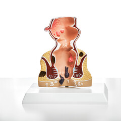 Proctology, treatment of rectum and anal intestinal diseases, hemorrhoids