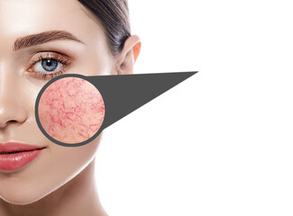 Magnifying glass showing couperose on face skin. Woman showing problems couperose-prone sensitive...
