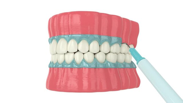 Professional teeth bleaching over white background