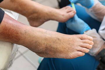 Leg vein disease, dark spots on the skin of the legs, treatment, examination of toenails, fungus....