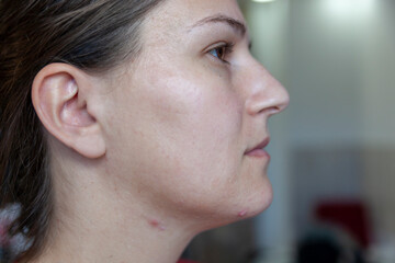 Acne and after therapy.-Despair of adults