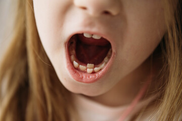 Adult permanent teeth coming in front of the child's baby teeth: shark teeth. Little girl's open...