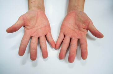 Palm of the hand with skin disease on a white background