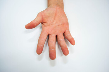 Palm of the hand with skin disease on a white background