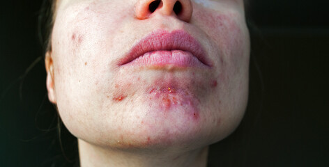 Close up Woman with problematic skin and acne scars. Problem skincare and health concept. Young...