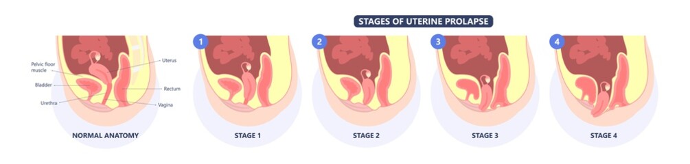 Pelvic floor prolapse type uterine uterus biofeedback pelvic floor treatment stage degree Kegel exercise surgery surgical therapy disorder cystocele urethrocele vaginal vault enterocele urethral exam