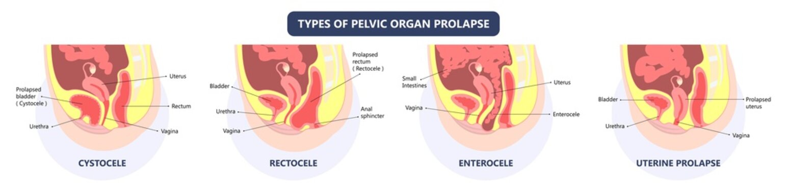 Pelvic floor prolapse type uterine uterus biofeedback pelvic floor treatment stage degree Kegel exercise surgery surgical therapy disorder cystocele urethrocele vaginal vault enterocele urethral exam
