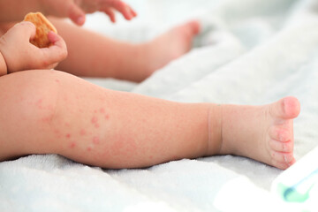 A small child with a red rash on the leg sits on the bed. Children is allergies.