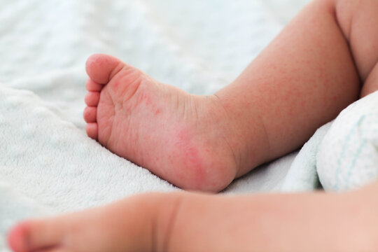A small child with a red rash on the leg sits on the bed. Children is allergies.