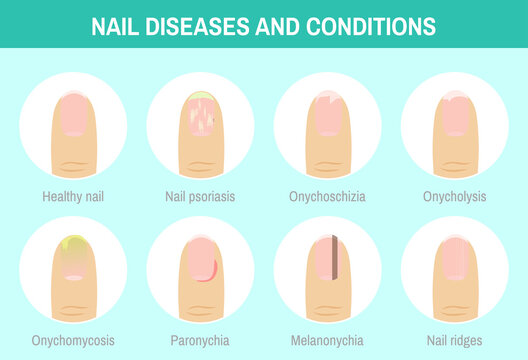 the clinical and dermatoscopic features of common nail disorders a and   Download Scientific Diagram